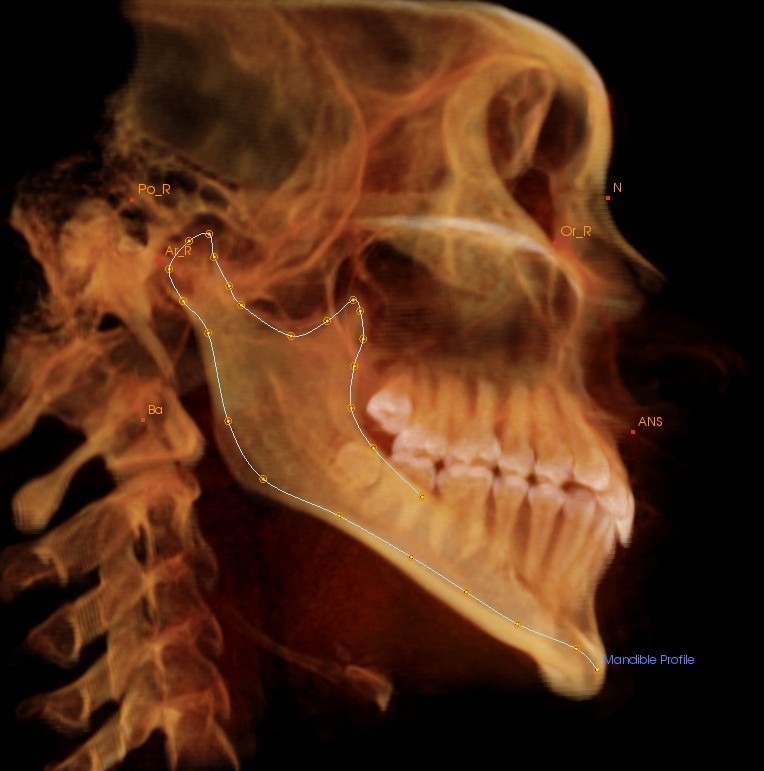 Томография для ортодонтии